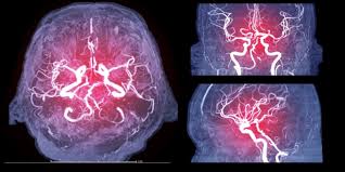 /Cerebral catheterization